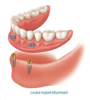 Tooth Implant Cornwall