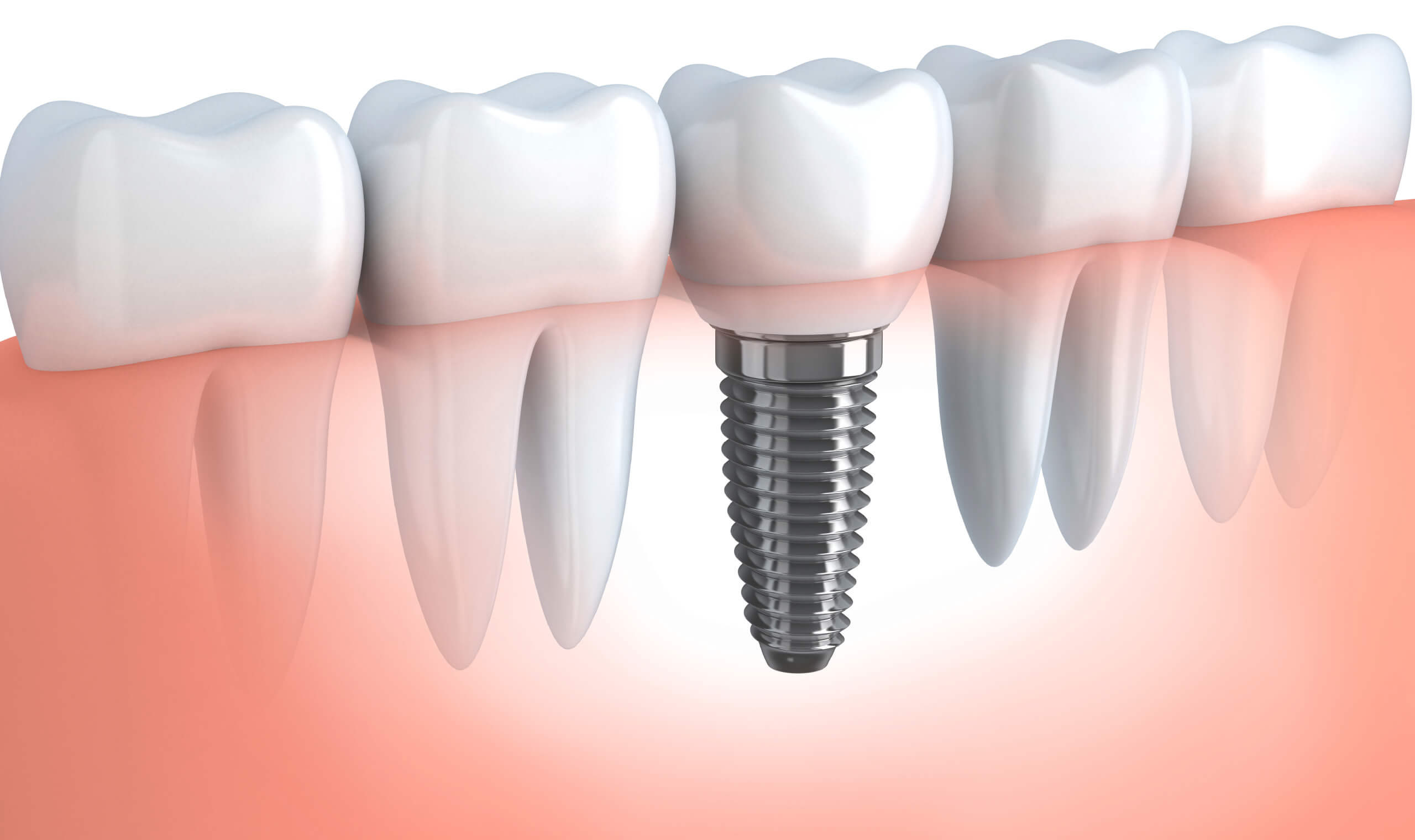 Dental Implant Cornwall