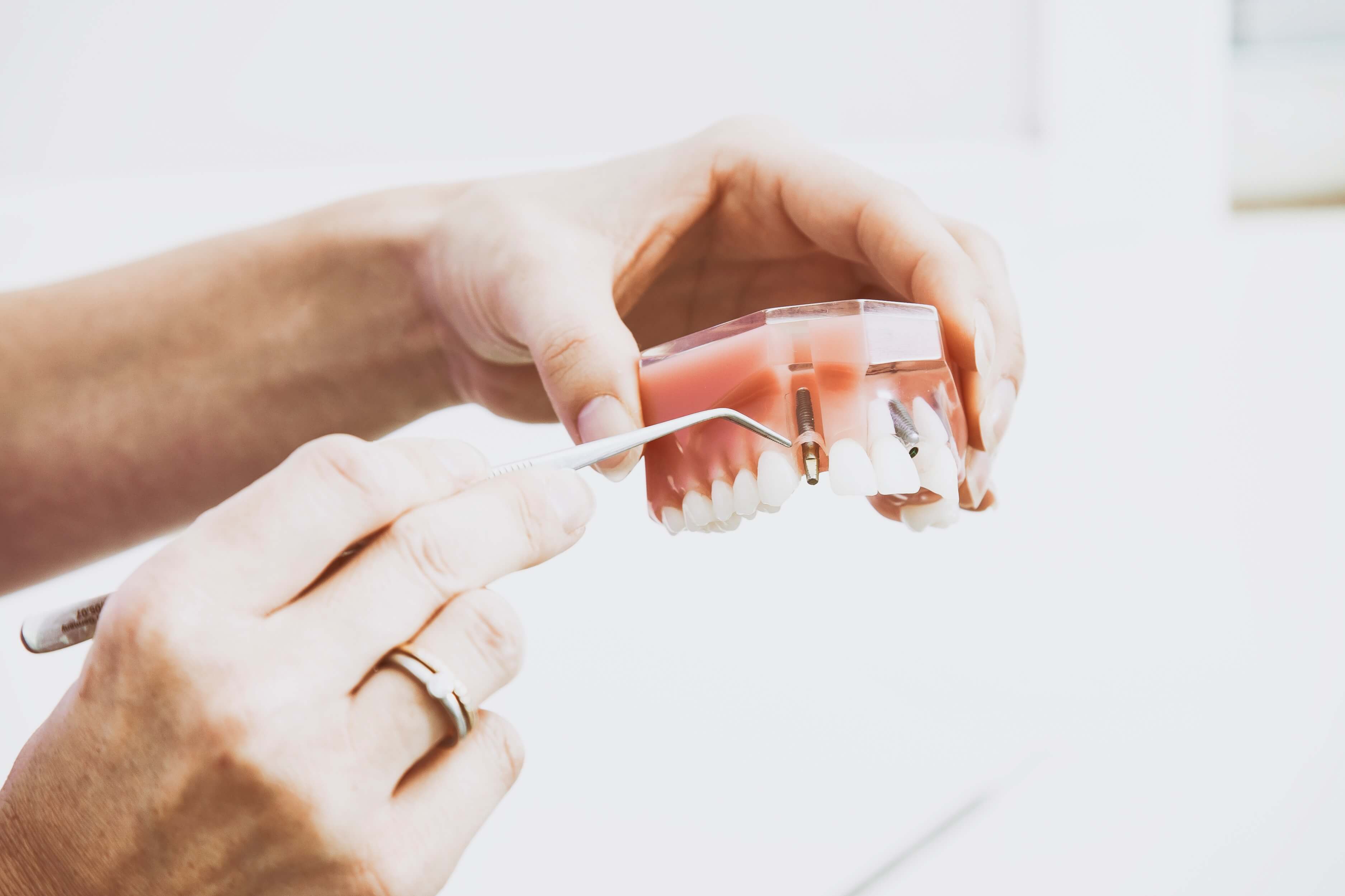 Dental Implant Cornwall
