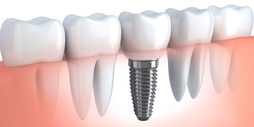 Cost of Dental Implants Cornwall