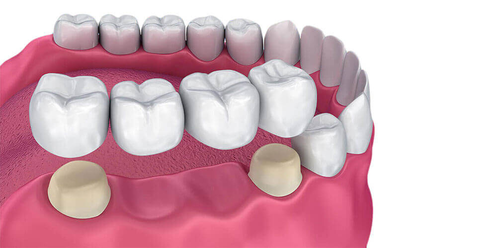 Dental Bridges Cornwall