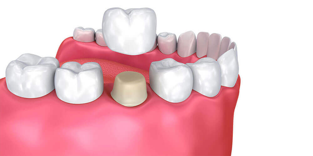 Dental Crowns Cornwall