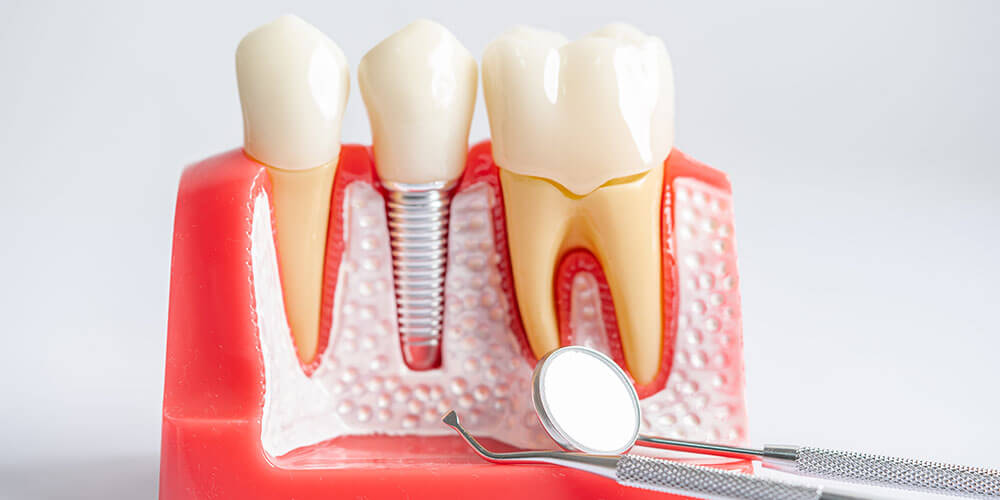 Dental Implants Cornwall