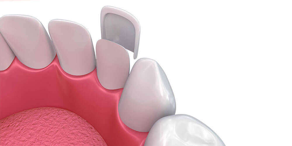 Dental Veneers Cornwall