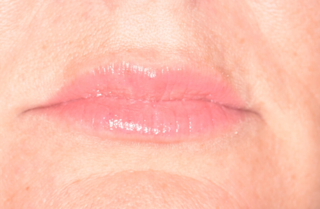 Lip Fillerss - After Lip Fillers