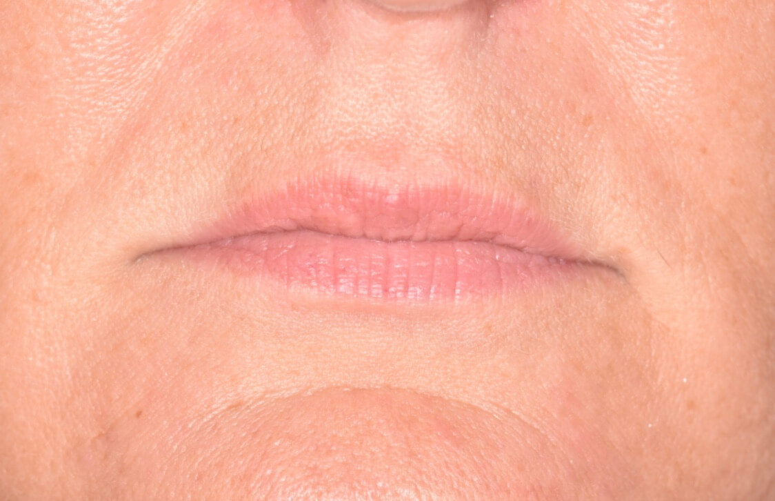 Lip Fillers - Before Lip Fillers