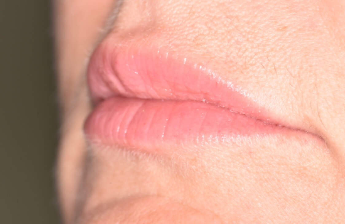 Lip Fillers - After Lip Fillers