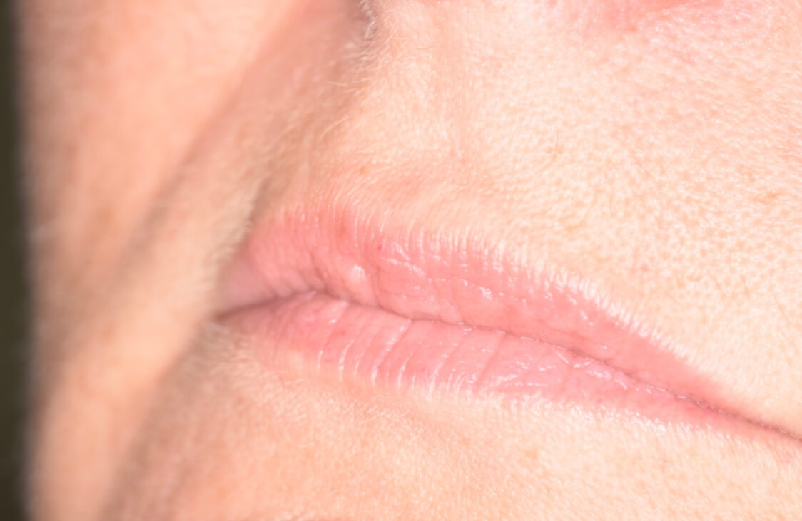 Lip Fillerss - Before Lip Fillers
