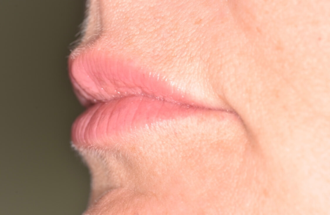 Lip Fillers - After Lip Fillers