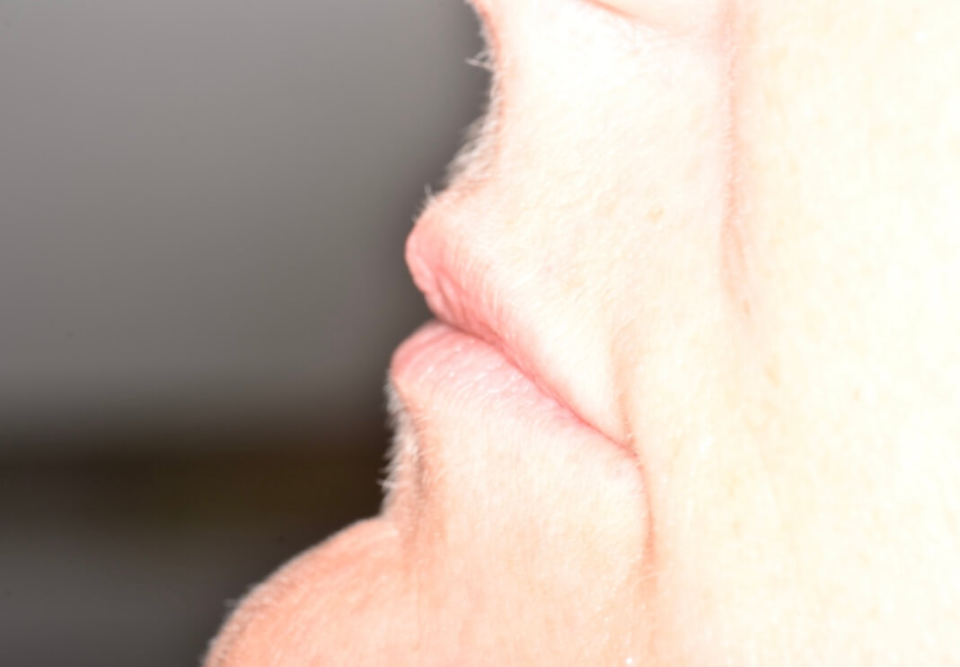 Lip Fillerss - Before Lip Fillers